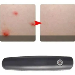 New Klostillande penna, Myggbett, Lindring, Bett, Hjälppenna, Insekt, Klådstillande enhet, Insektsmedel--.pa